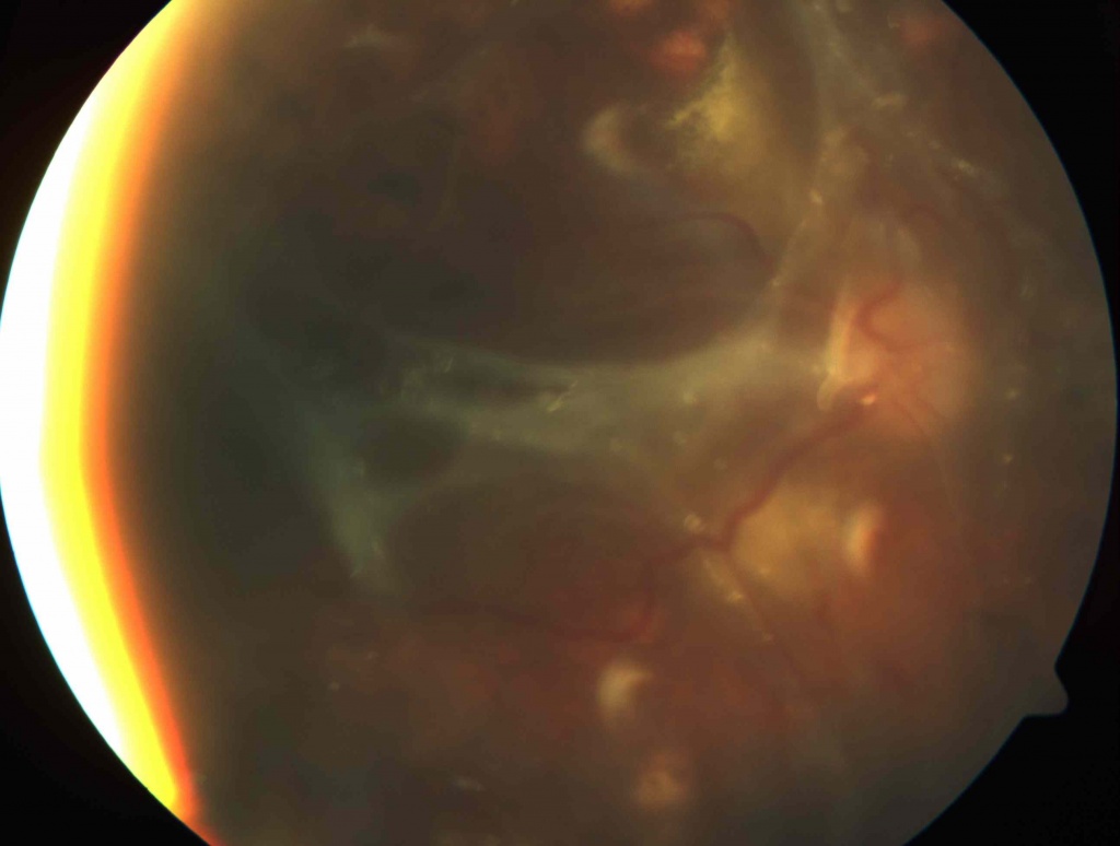 Диабетическая ретинопатия.jpg